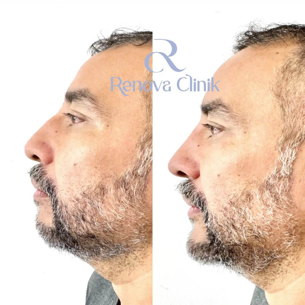 Armonización del Perfil Facial